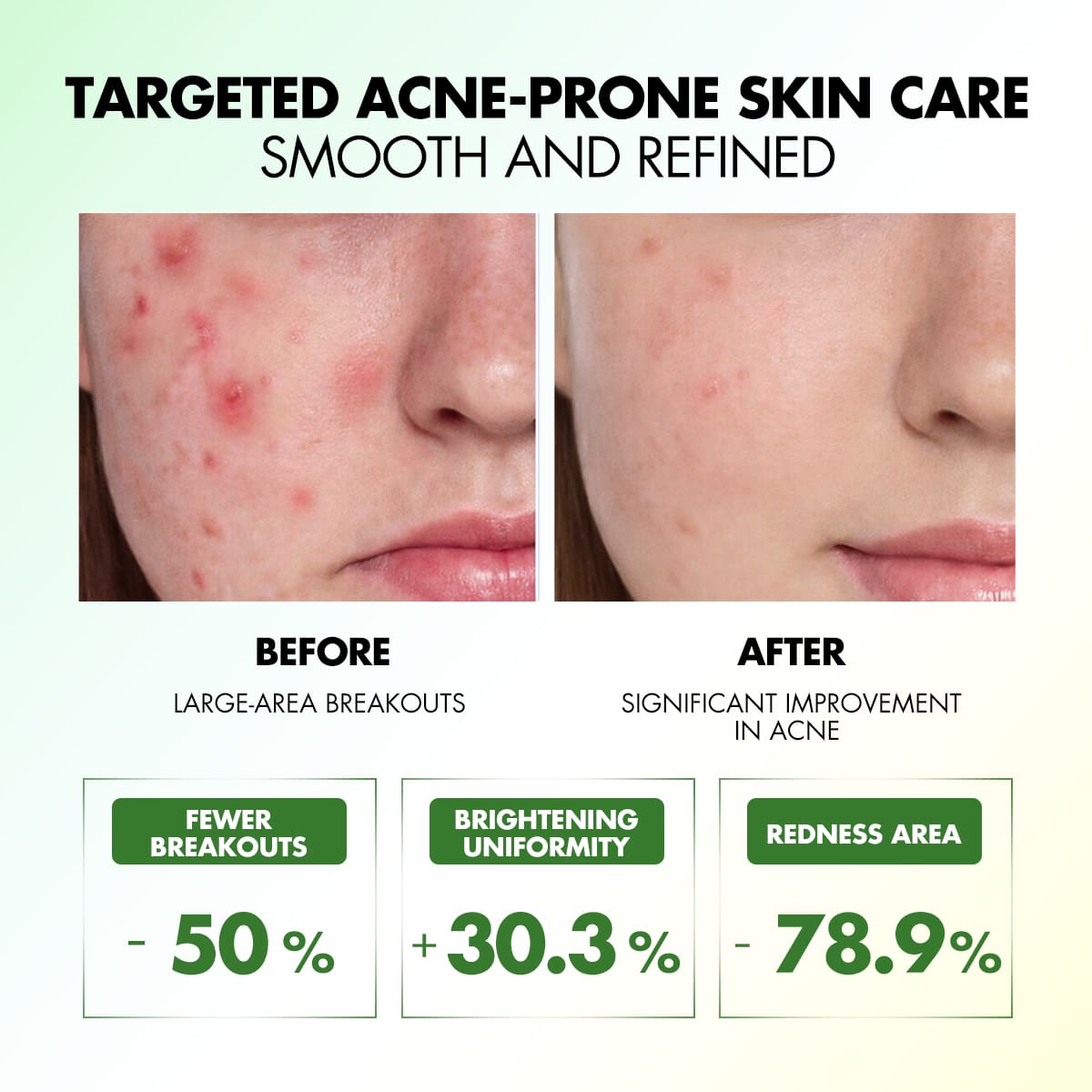 SPOTLESS ACNE CARE SERUM